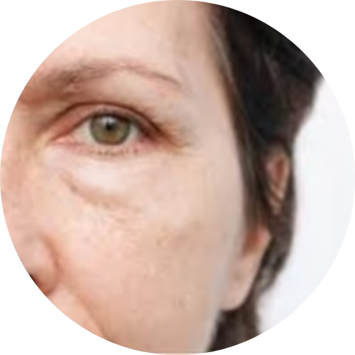 Puffiness
