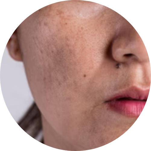Dark spots