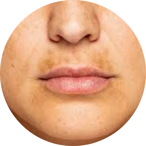 Uneven skin tone