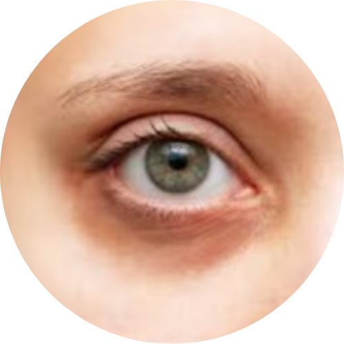 Dark circles
