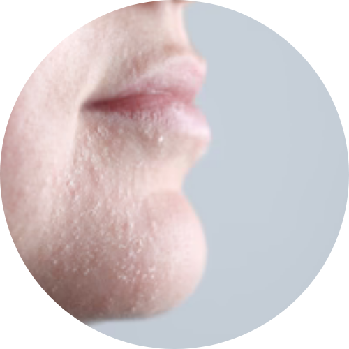 Dry skin