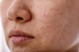 KANSA GUA SHA